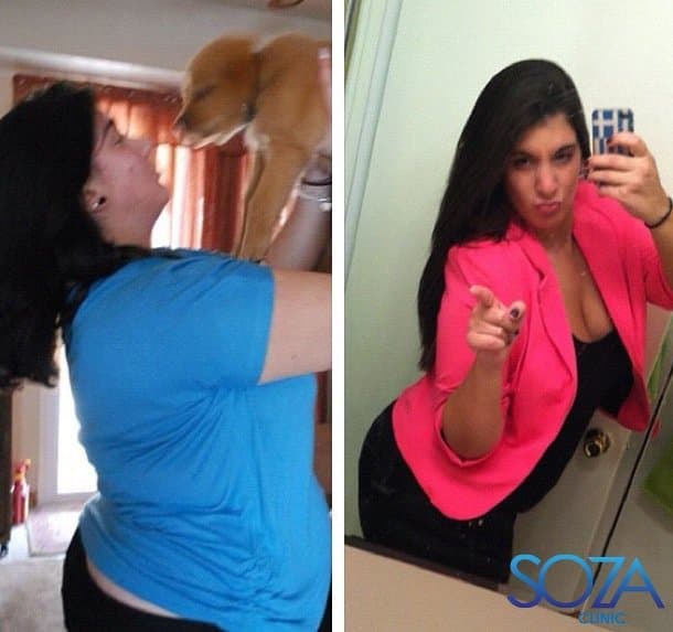 Soza Clinic patient before and after, photo 31