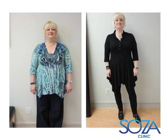 Soza Clinic patient before and after, photo 37