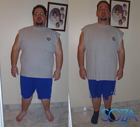 Soza Clinic patient before and after, photo 41