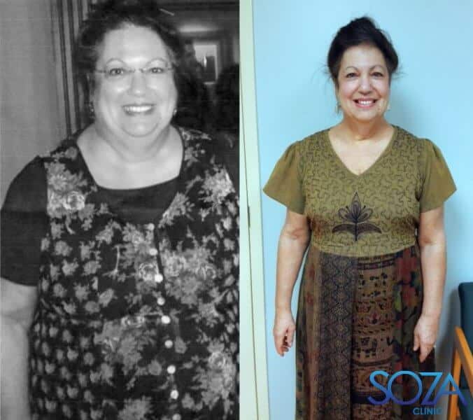 Soza Clinic patient before and after, photo 22