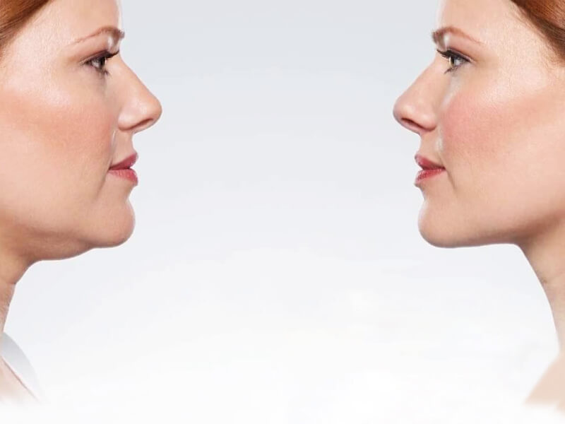 kybella
