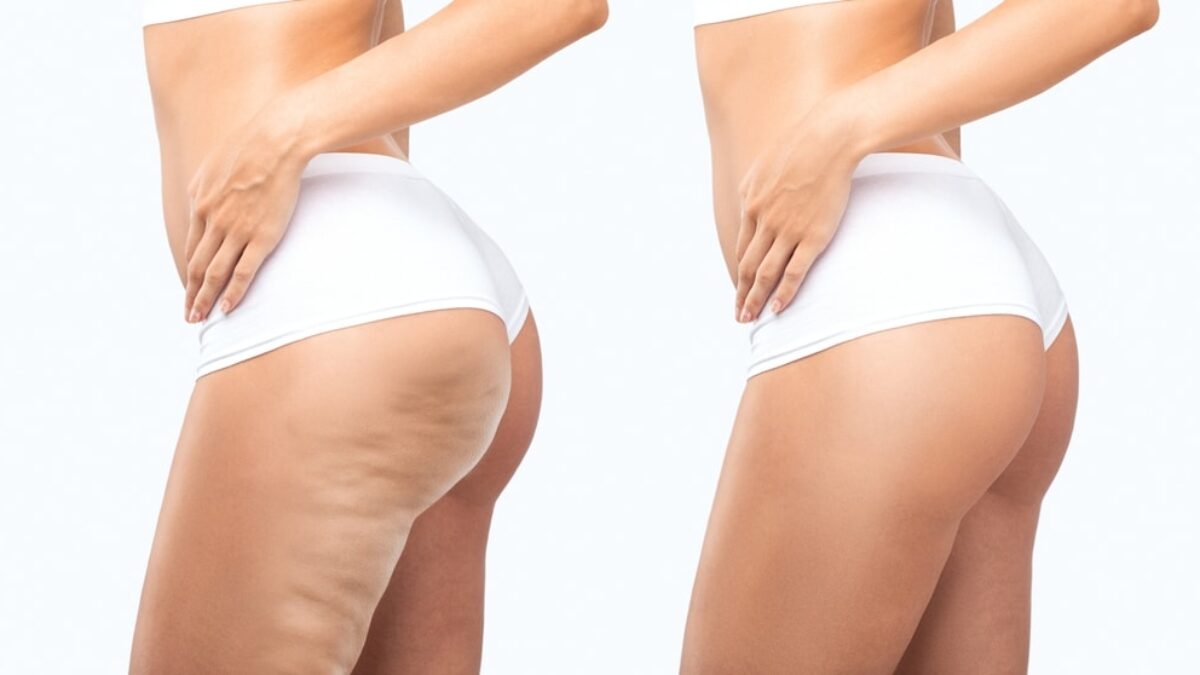 Cellulite: Can Stress Worsen Its Appearance?