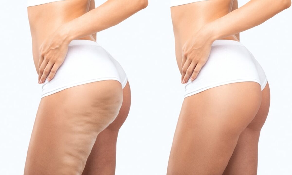 b12 injections cellulite Cellulite: Can Stress Worsen Its Appearance?