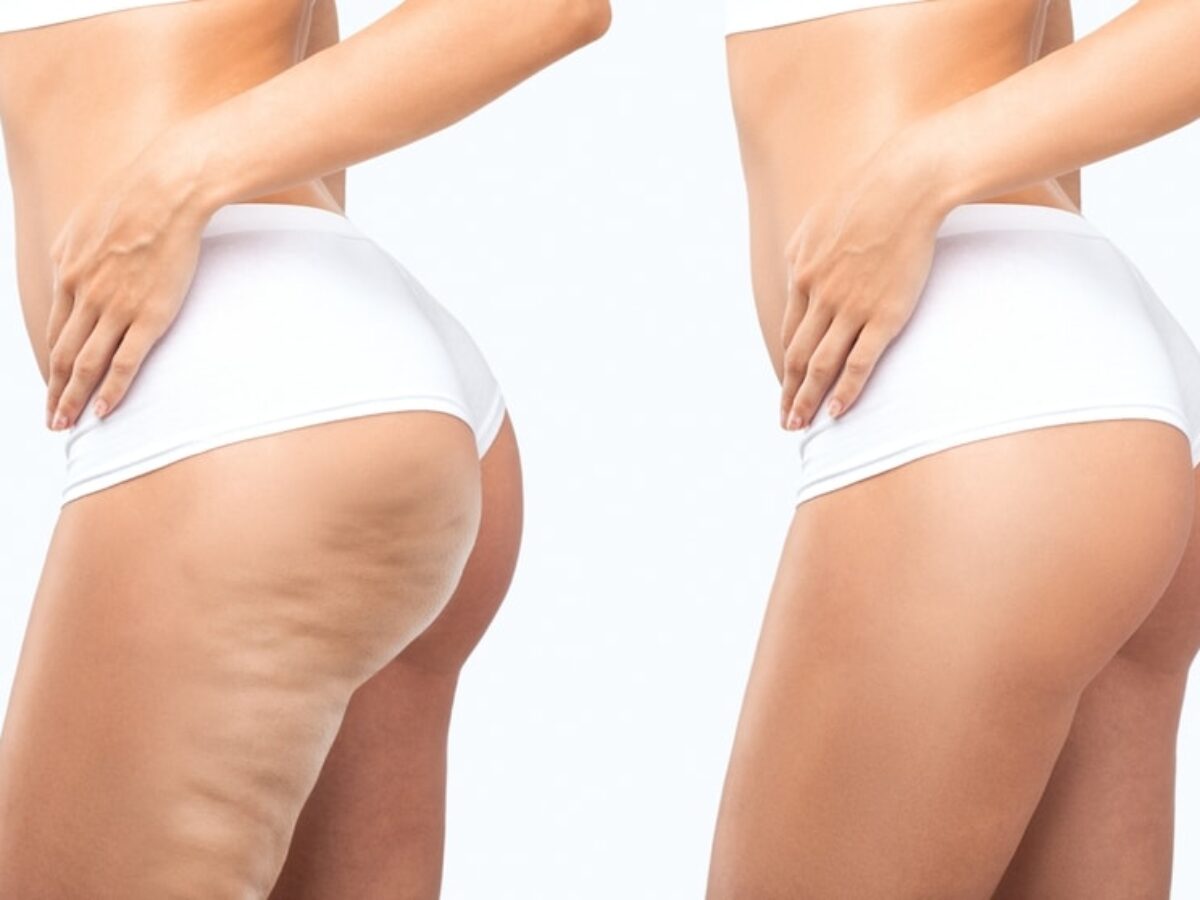 Cellulite: Can Stress Worsen Its Appearance? | Soza Clinic