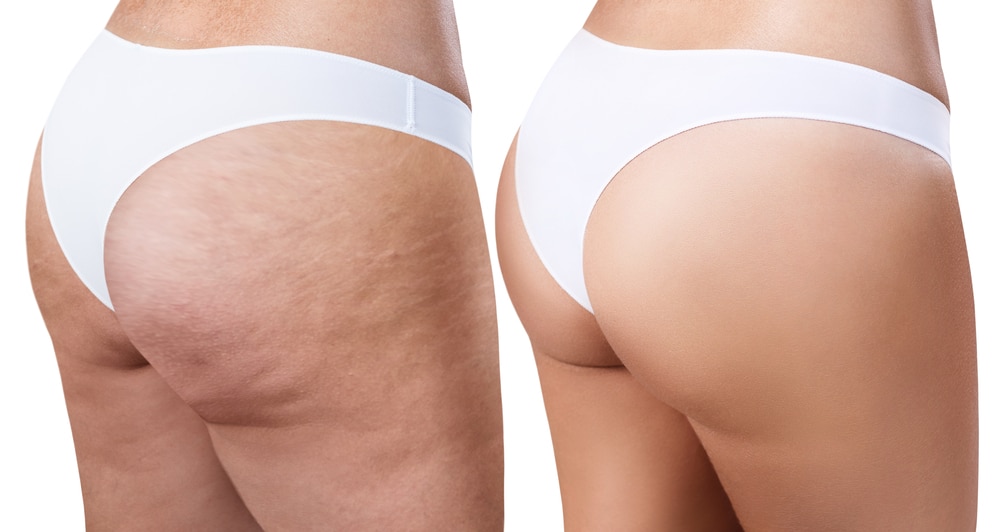 Cellulite Treatment Soza Clinic