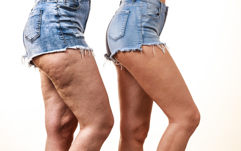 Cellulite | Soza Clinic