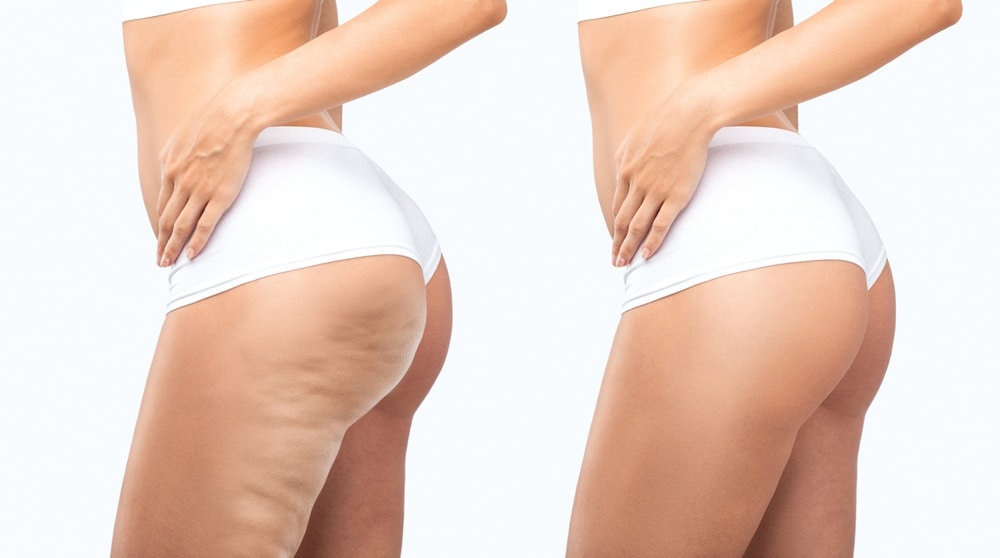 Cellulite | Soza Clinic