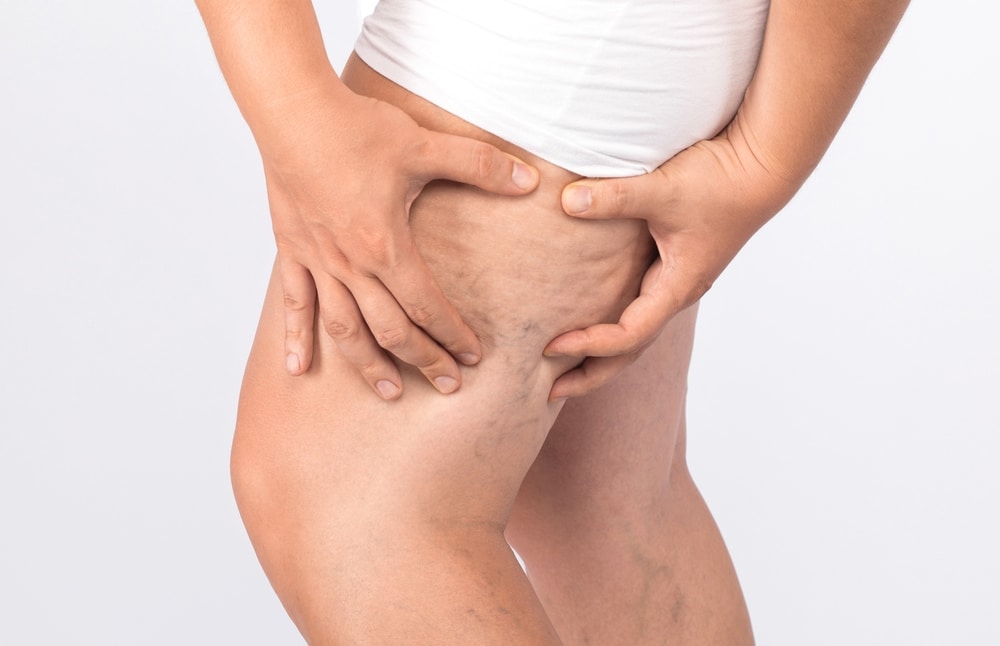 Cellulite in Men | Soza Clinic